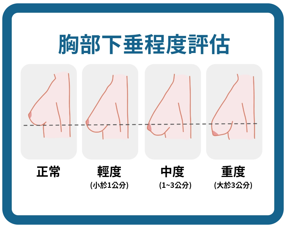 胸部下垂程度評估