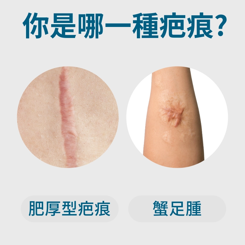 肥厚性疤痕跟蟹足腫一樣嗎?