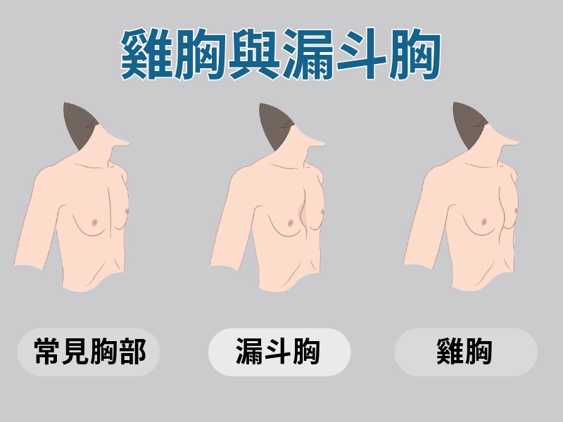 雞胸與漏斗胸